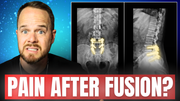 Still Have Back Pain After Spinal Fusion? Here’s What Your Doctor Won’t Tell You
